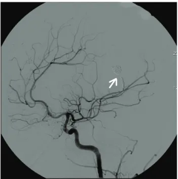 FIGURE 3   Postembolization arteriogram with coils, as indicated  by the white arrow.