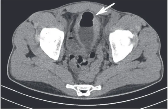 FIGURE 1   Contrast-enhanced computed tomography of the  abdomen showing the presence of gas in the bladder (white arrow).
