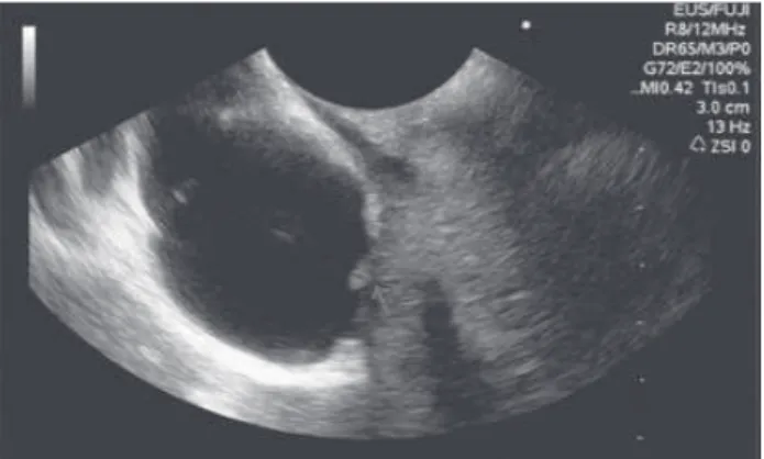 FIGURE 3   Echo-guided puncture to obtain sample material from  the lesion. 