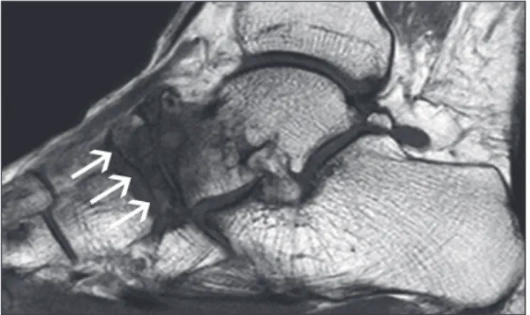 FIGURE 3   T1-weighted sagittal MRI of the right foot, showing  thinning with deformity similar to a “comma” of the navicular bone  (arrows), a pattern of bone edema and subchondral cysts in the talus  and navicular bones.