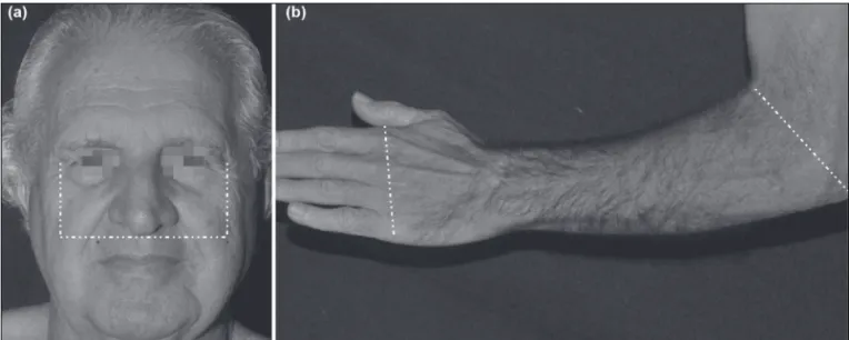 FIGURE 1   Standardized area for counting actinic keratosis on the face (a) and on the forearms (b).