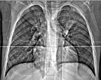 FIGURE 1   Severe bulbo-duodenitis with mild diffuse  bleeding.