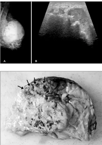 FIGURE 1   Imaging findings. (A) Mammogram showing a  relatively well-defined, irregular, hyperdense mass