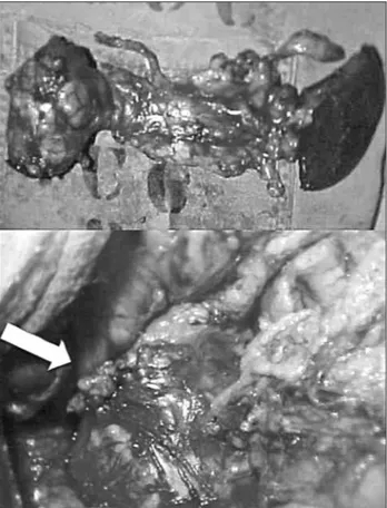 FIGURE 3   Product of body-caudal pancreatectomy (approximate- (approximate-ly 80% of the pancreas) and total splenectomy with tumor evident to  the left of the image