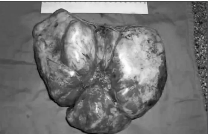 FIGURE 1   Tumor mass in the right hemithorax.