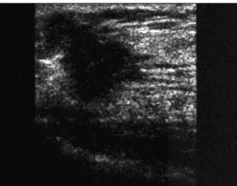 FIGURE 3   Sonographic appearance of breast cancer. Irregular  spiculated nodule.