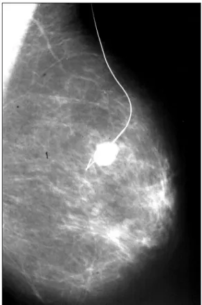 FIGURE 5   Intraoperative localization with gamma ray detection  probe – ROLL.