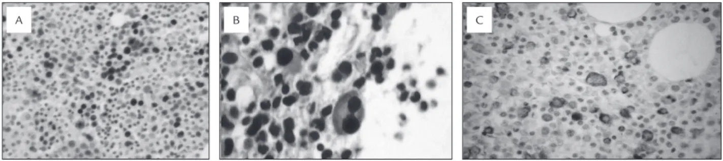 FIGURE 1.  Images from Case 1. A- Strong nuclear staining (40%) of p53 protein in granulocytic precursors