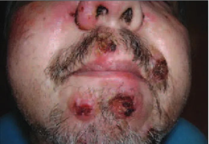 FIGURE 2   Detail of ulcerated nodular lesions in the chin region.