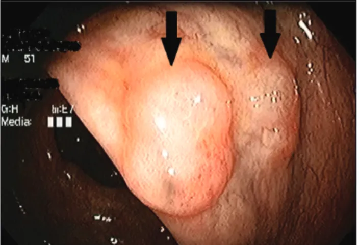 FIGURE 1   Colonoscopic view of subepithelial lesions in the  ascendant colon (black arrows).