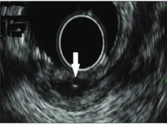 FIGURE 4   Endoscopic ultrasound images of the rectal lesion  showing a predominantly hypoechoic lesion with a linear hyperechoic  image in its interior (white arrow).