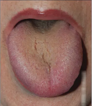 FIGURE 2   Tongue with diffuse yellow coating, with a slight  deviation to the left. 