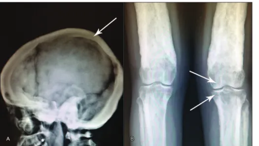 FIGURE 2   A. Radiography of skull  in profile. Note the diffuse cortical  thickening of the skull cap (arrow)
