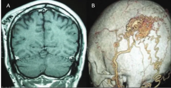 FIGURE 1   A. Coronal T1-W MRI showing the scalp AVM on the left  parieto-occipital region