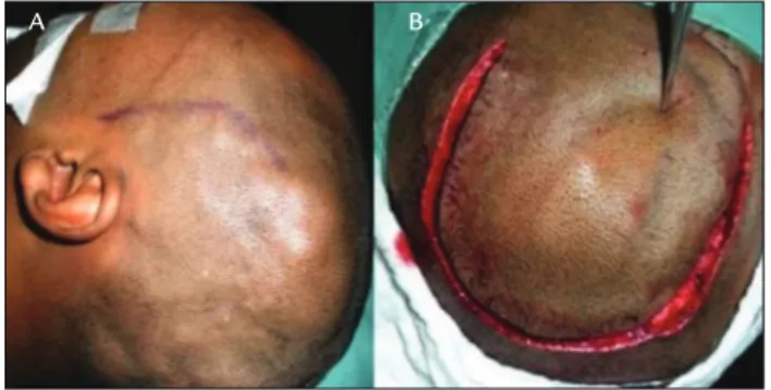 FIGURE 2   A. Soft thickened scalp can be seen above the left  temporal and occipital skull surfaces, corresponding to the scalp  AVM