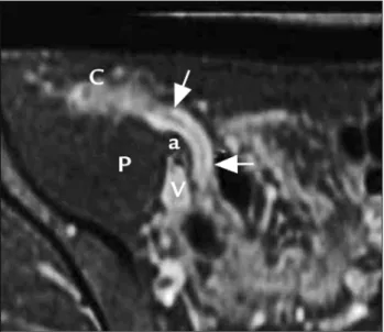 FIGURE 1   Ultrasonography. Appendix with thickened walls (4 mm)  and loss of normal stratification