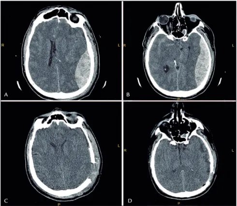 FIGURE 1   A and B. Pre-op CT scan image. C and D. Post-op CT scan image.