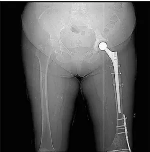 FIGURE 1   Panoramic X-ray showing numerous radiopaque riziform images in the soft tissues of the thighs.