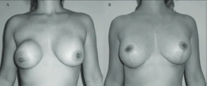 FIGURE 1   A. A 40-year-old female patient who underwent mammoplasty 10 years before and developed capsular contracture on the right