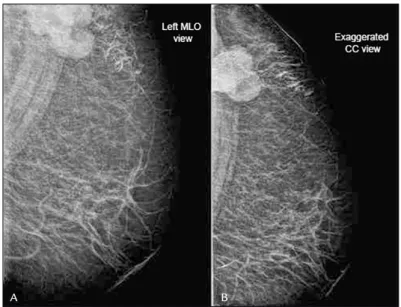 FIGURE 1   Left mammogram shows oval mass without microcalcifications and with circumscribed margins.