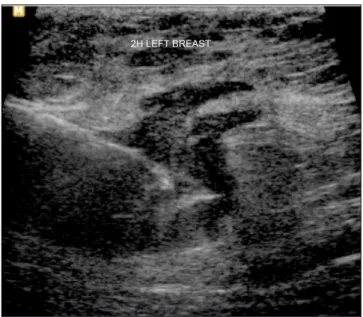 FIGURE 3   Ultrasound-guided core needle biopsy of the lesion.