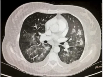 FIGURE 1   Chest CT scan, axial lung window. See areas of ground  glass opacity diffusely in both lungs.