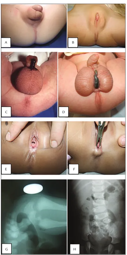 FIGURE 1   A. High anorectal anomaly in a male newborn, 24 hours after birth – note the absence of the anus and any oriices indicating  perineal istula