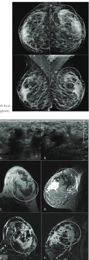 FIGURE 2   Ultrasonography showing a heterogeneous, predominan- predominan-tly hypoechoic area, with indistinct margins, in the upper-outer quadrant 