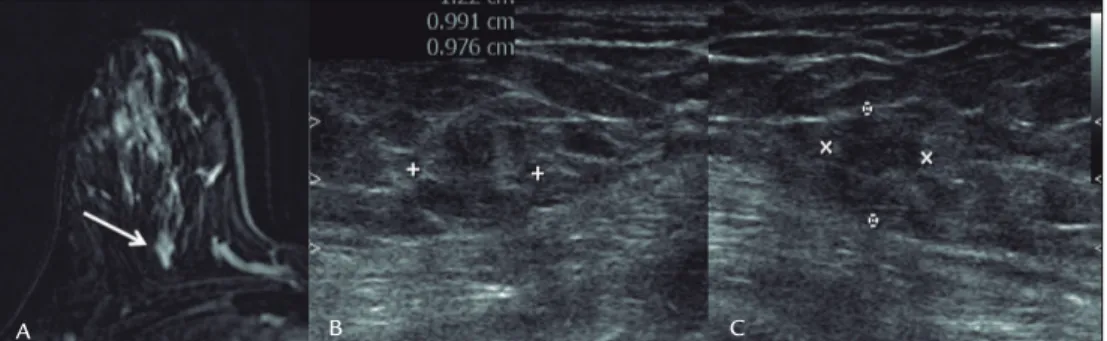 FIGURE 3   MRI (A) showing a mass enhancement at the upper quadrants of the right breast (arrow)