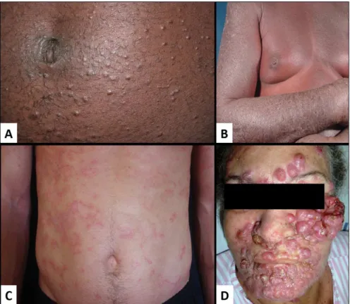 FIGURE 1   Examples of cutaneous lesions observed in ATL. A. Chronic form with papular pattern