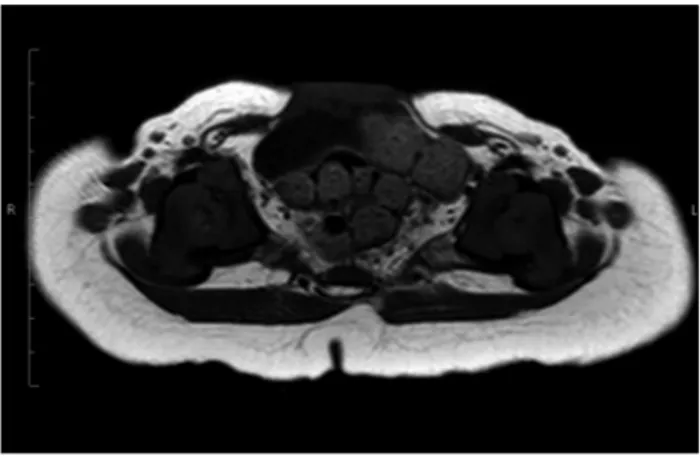 FIGURE 2   Axial T1 MRI. Insinuation of the anterior wall of the bladder  and bowel loops through lateral opening in the rectus abdominis muscle.