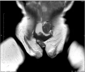 FIGURE 3   Coronal T2 MRI. Ectopic testes located in subcuta- subcuta-neous tissue, anterior surface of the thighs.