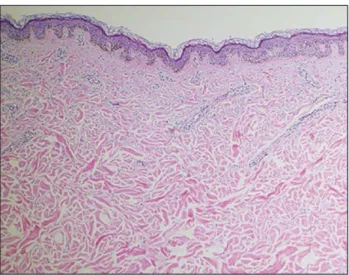 FIGURE 2   Thickened dermis, forming gaps between collagen  bundles.