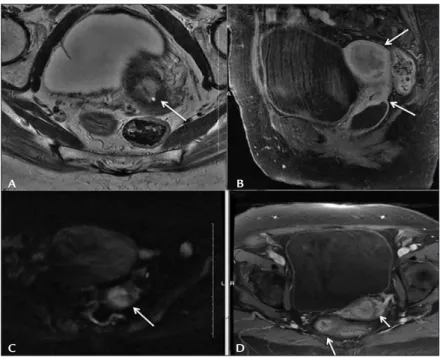 FIGURE 2   Imaging findings: T2-weighted MRI sequence on axial (A) view shows slightly hyperintense lesion occupying the cervix (arrow); 