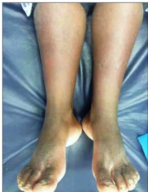FIGURE 2   Diffuse erythema and edema in the lower limbs.