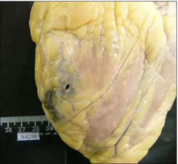 FIGURE 1   Case 3: Heart with a recent infarction corresponding  to the upper-posterior area of the left ventricle and a recent rupture  of 0.5 cm.
