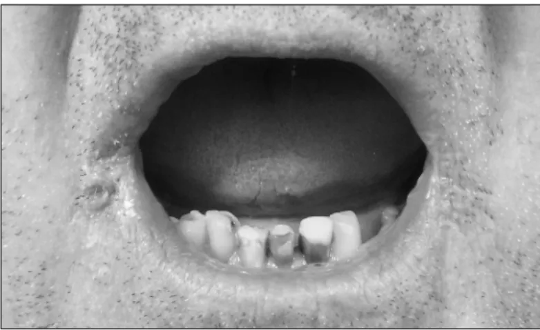 FIGURE 2   Papule located at the right angle of the upper lip.