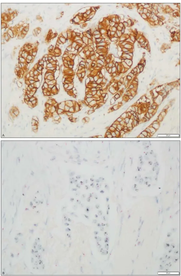 FIGURE 1   A. Representative microphotograph of a breast cancer specimen classiied with a score of 3+ by immunohistochemistry (400x)