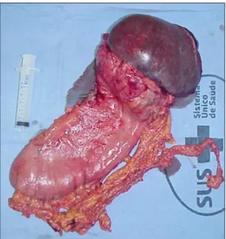 FIGURE 3   Surgical specimen of stomach and spleen, sagittal section showing gastric perforation contiguous to splenic perforation.