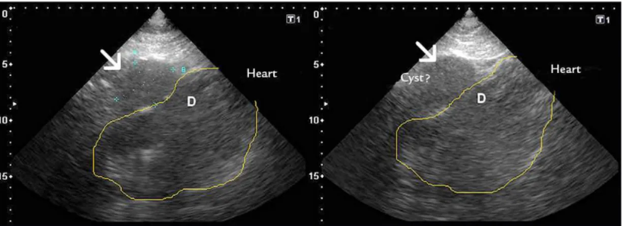 FIGURE 2   A and B. Echocardiogram showing a hypoechoic oval image (thin arrow) adjacent to the right cardiac chambers that causes slight  compression in the latter.