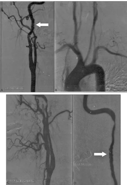 FIGURE 1   Digital luoroscopy angiography. A. Right carotid, oblique view. B. Aortic arch, oblique view