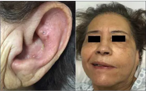FIGURE 1   A. Auricular vesicles at the left pinna. B. Left peripheral facial paralysis House-Brackman IV, 149 x 91 mm (96 x 96 DPI).