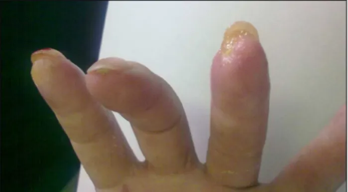 FIGURE 1   Example of digital ulcers in the left hand of patient  number 4 prior to treatment with bosentan.