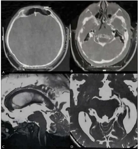 FIGURE 1   A. Wormian bones in a brachycephalic skull. B. Skull base abnormality. C. Basilar invagination obliterating the prepontine  subarachnoid space, with compression of the brainstem