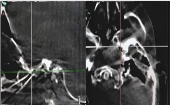 FIGURE 2   Submental view of the cannula positioned at the foramen ovale. 