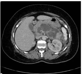 FIGURE 2   CT scan performed 10 days after admission, showing  luid collection and necrosis (WON).