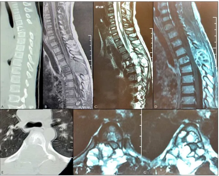 FIGURE 2   This 5 year-old patient was brought to the emergence department with 2-week progressive leg weakness and thoracic pain