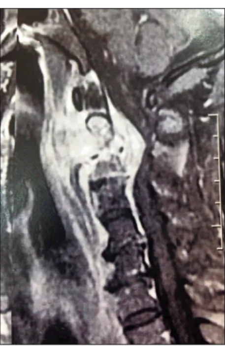 FIGURE 1   Cervical NMR image showing signs of spondylodiscitis  in C2-C3 with spinal cord compression and epidural abscess.