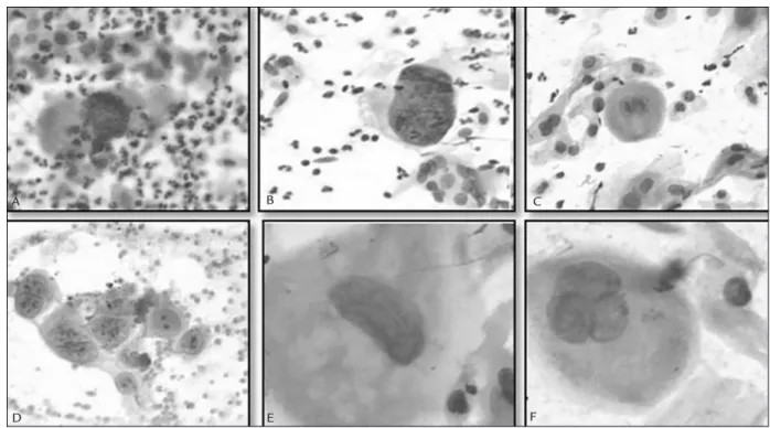 FIGURE 1   Actinic cytopathological aspects.