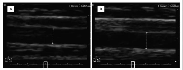 Figure 1 - High resolution linear ultrasound measurement of brachial artery diameter before stimulus (A) and 60 seconds after  5 minutes with forearm compressed (B)